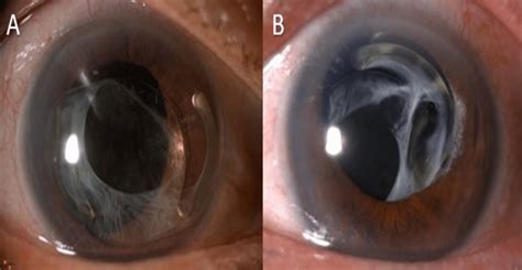 Cureus Bilateral Sequential Spontaneous Anterior Dislocated