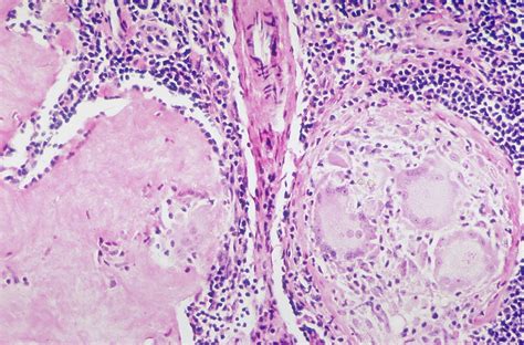 Sarcoidosis Fibrosis Of Granulomas When Sarcoid Granulom Flickr