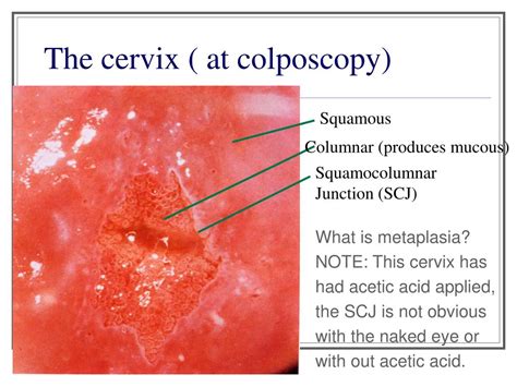 Ppt Cervical Malignancy And Pre Malignancy Powerpoint Presentation Free Download Id