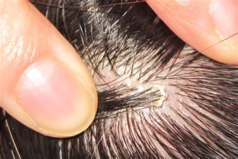 Pin On Itchy Scalp Treatment