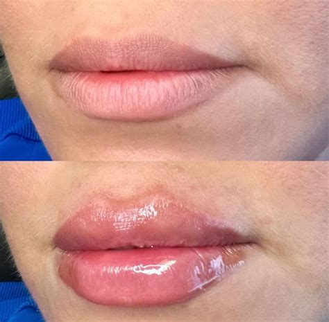 Before And After Lip Injections Gallery Dr Anthony Bittar