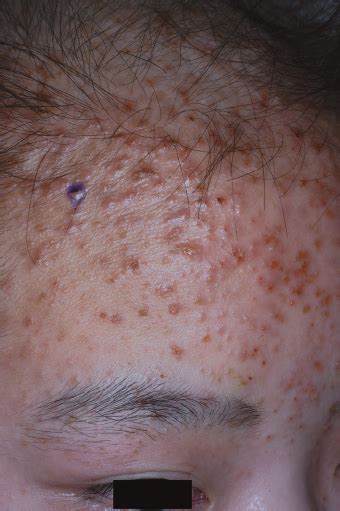Clinical Finding Of Follicular Reddish Papules With Occasional Pustules