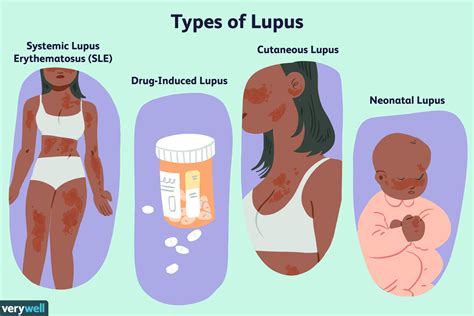 Lupus Treatment Options