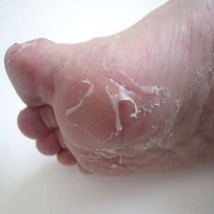 11 Easy And Effective Cures For Peeling Skin | Search Herbal & Home Remedy