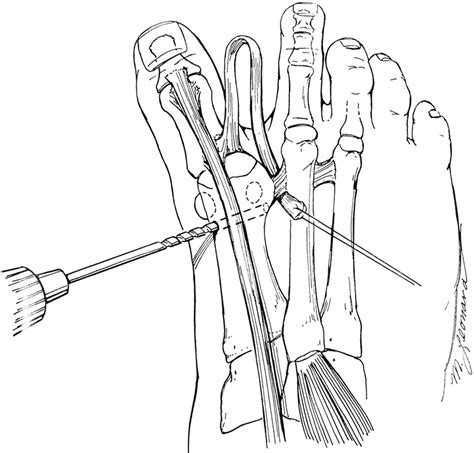 Tendon Transfers About The Hallux Foot And Ankle Clinics