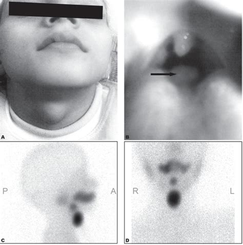 The Same Patient At The Age Of 8 Years With Neck Swelling Clinical