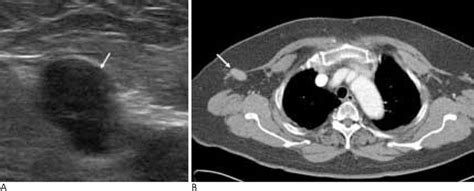 Radiologic Findings Of Various Diseases Of The Axillary Lymph Node With