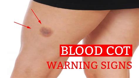 Signs And Symptoms Of Leg Clots 7 Warning Signs And Symptoms