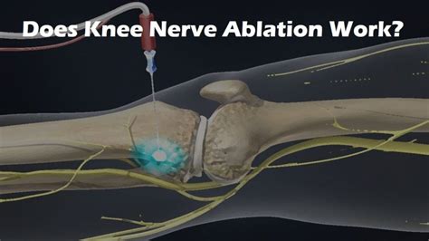 Nerve Ablation Knee