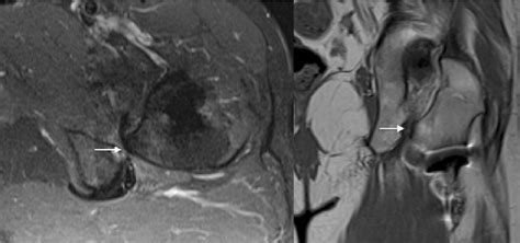 Axial Stir And Coronal T1 Images Of The Left Hip In A 58 Year Old