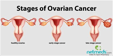 Ovarian Cancer Causes Symptoms And Treatment