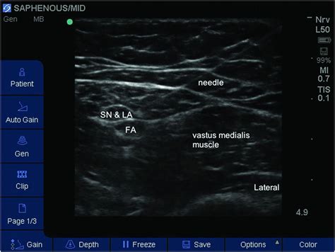 Ultrasound Guided Saphenous Nerve Block Anesthesia Key