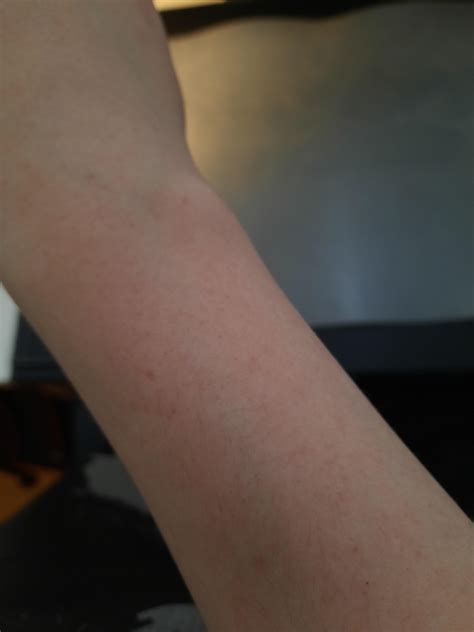 Tiny Red Dots On Right Arm They Arent Itchy And There Seem To Be