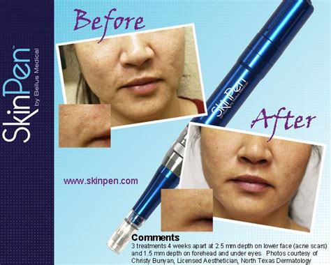 Pin On Before And After Skinpen Treatments