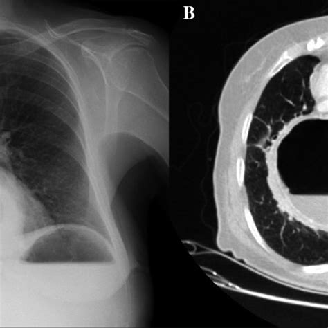 A Chest X Ray Shows The Presence Of A Gastric Air Bubble In The Chest