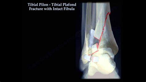 Tibial Pilon Fracture With Intact Fibula Everything You Need To Know