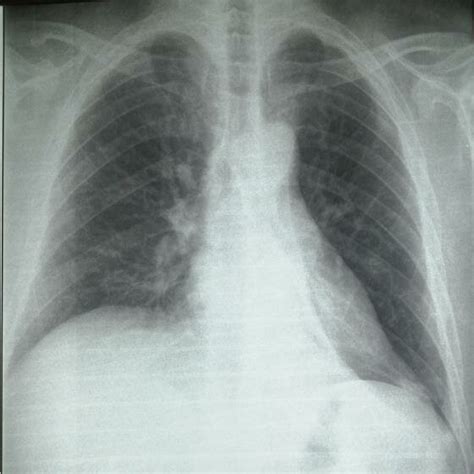 Frontal Chest X Ray Shows Atelectasis Of The Left Lower Lobe Left Basal