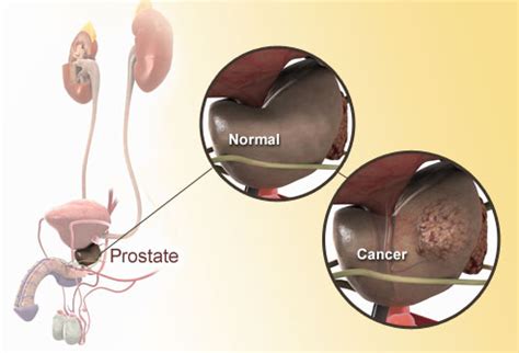 The processes for accessing the prostate as part of a medical exam (which should be done by a doctor). Le guide du cancer de la prostate | Manger Méditerranéen