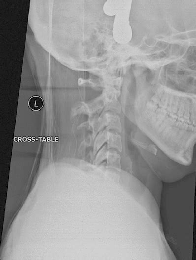 Lateral View Cervical Spine X Ray Alignment After 8 Pounds Traction