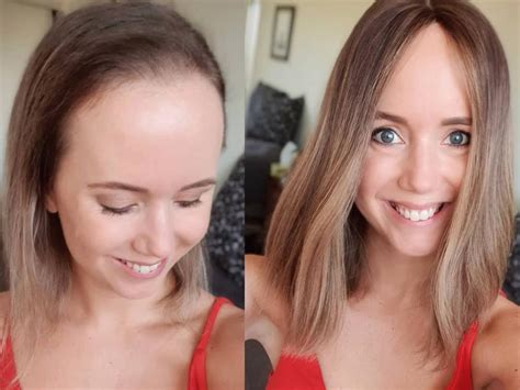 Alopecia Woman Shares Amazing Hair Loss Journey On Instagram The