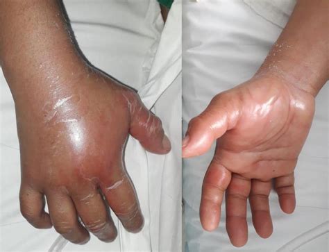 Compartment Syndrome Of The Hand After Laparoscopic Gynecologic Surgery