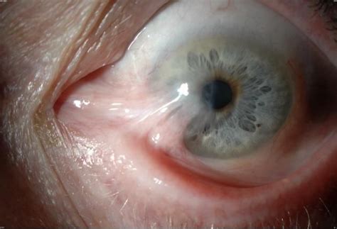 A sedative followed by an. 47 best images about Pterygium (Surfer's Eye) on Pinterest ...