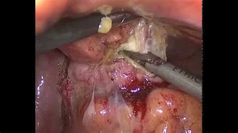 Laparoscopic Sigmoid Colon Resection In The Management Of A Year Old