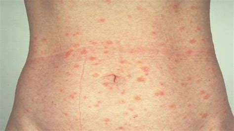 Pityriasis Rosea Is A Common Itchy Rash That Heals On
