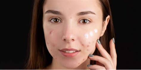 Acne 101 Understanding The Causes And Types Of Acne