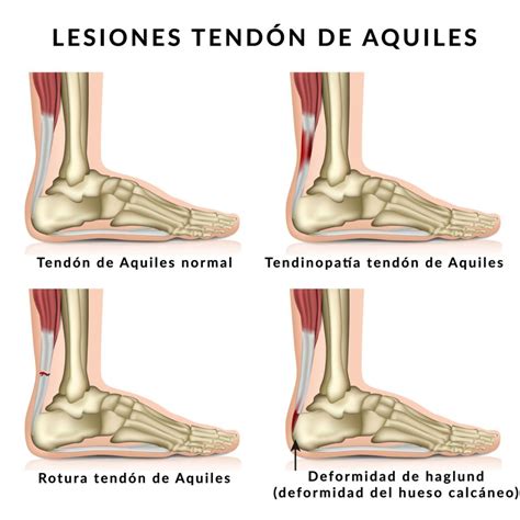 Tendinopatía Del Tendón De Aquiles Qué Es Y Cómo Tratarla