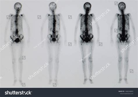 Bone Scan Scintigraphy Image Showing Multiple Stock Photo Edit Now