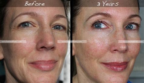 Retin A For Wrinkles 3 Year Results Before And After Hotandflashy50