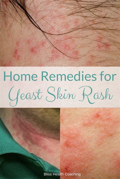 Skin Yeast Infection Home Remedies You Must Try Bliss Health Coaching