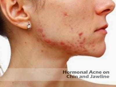 In acne patients of any age, most dermatologists will consider topical retinoids as the first step. Hormonal Acne on Chin and Jawline - Cause and Treatment ...