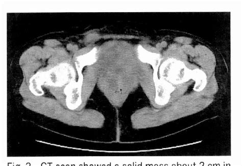 Figure 2 From A Case Of Inguinal Endometriosis Accompanied By External