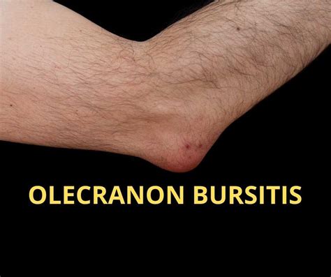 Olecranon Bursitis Elbow Bursitis Images And Photos Finder