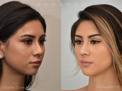 Plastic Surgery Photo Gallery Beverly Hills Enhance Medical Center