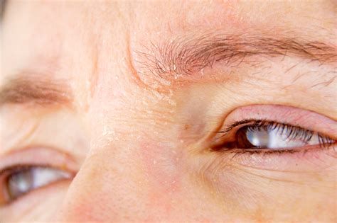 Psoriasis En Los Ojos Síntomas Y Tratamiento Blog De Clínica Baviera