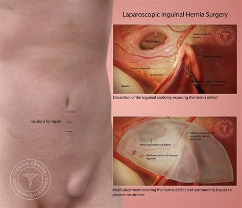 Google Hernia Repair Digestive System Medical Coding Hot Sex Picture