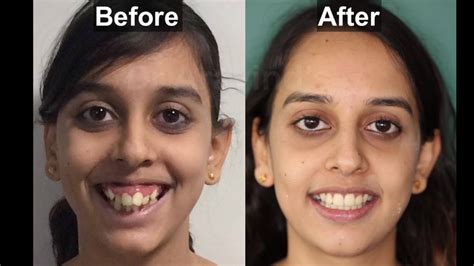 Braces Before And After Best Smile Transformation Gummy Smile Smile Design Mini