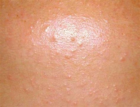 Closed Comedones Are Small White Or Skin Colored Papules Without