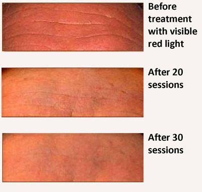 After a few months of regular use, i got tired of dealing with the clamp. Best At-Home Red Light Therapy Devices - Unbiased Reviews ...