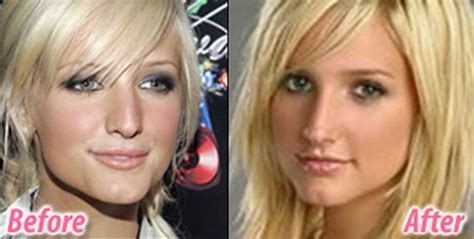 Ashlee Simpson Nose Job Before And After Cosmetic Surgery Nose Job
