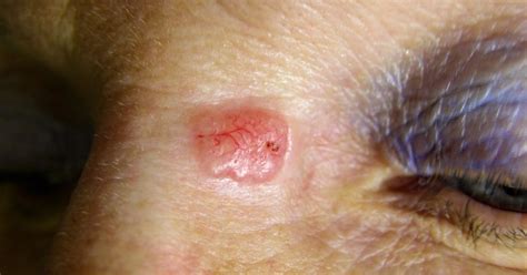 Skin Cancer On Nose Treatment