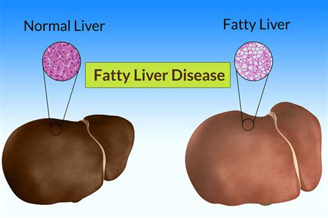Knowing About Fatty Liver Causes Signs Symptoms