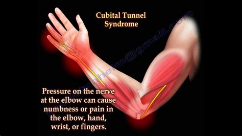 Cubital Tunnel Syndrome Carolina Regional Orthopedics