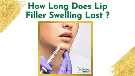 How Long Does Lip Filler Swelling Last