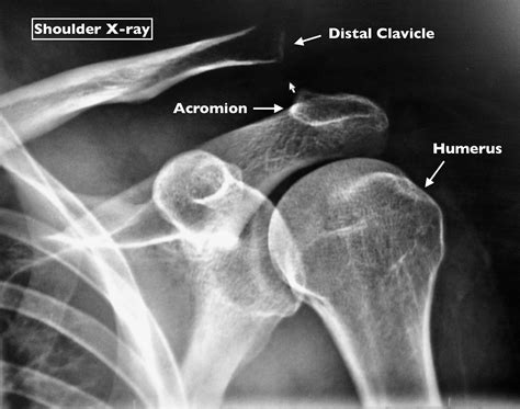 Acromioclavicular Injury Shoulder Separation