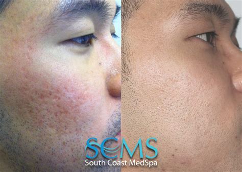 South Coast Medspa Announces Breakthrough In Treating Acne Scars On