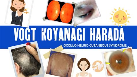 Vogt Koyanagi Harada Syndrome Vkh Granulomatous Uveitis